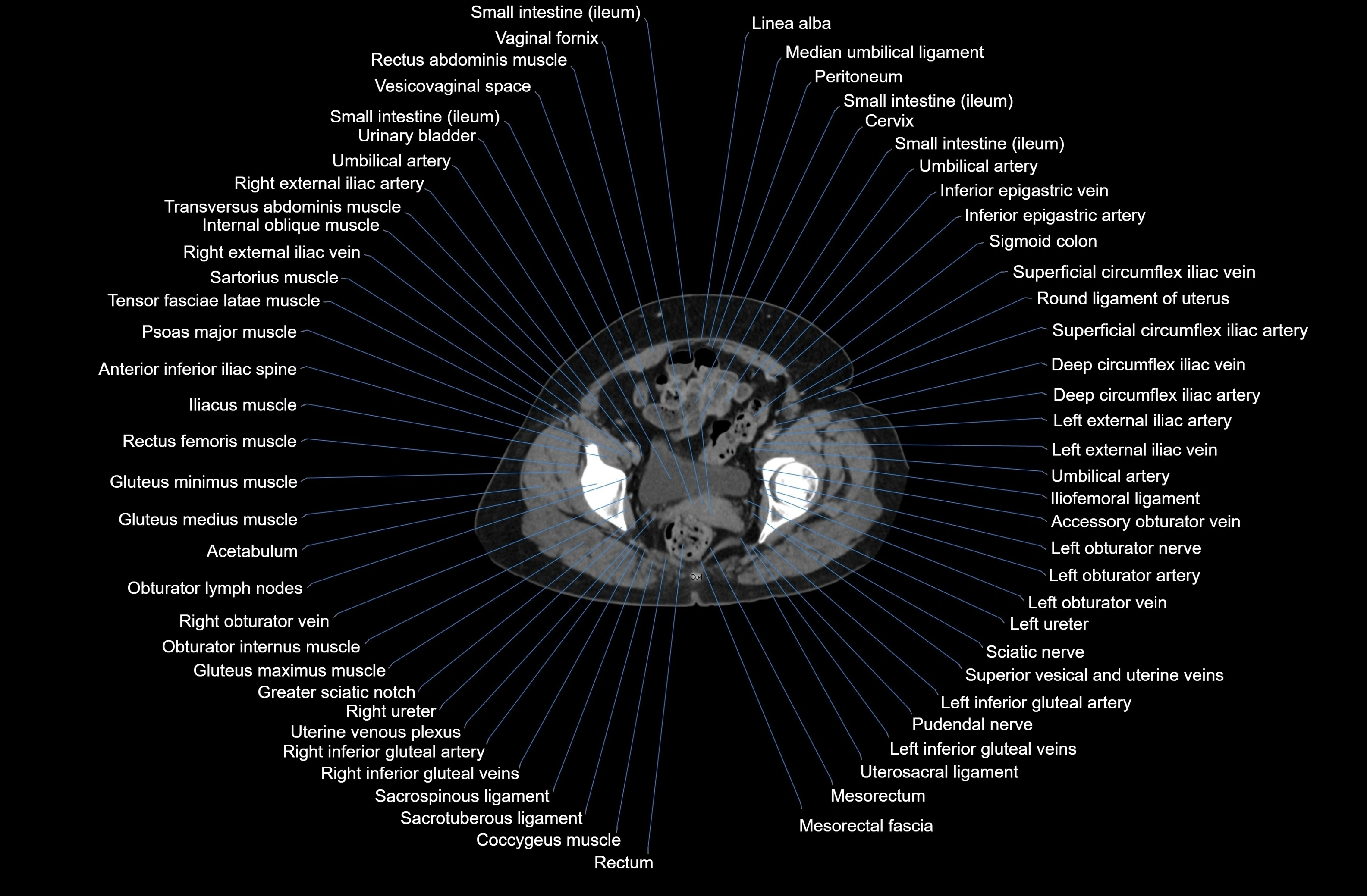 CT Abdomen axial cross sectional anatomy labelled radiology image-00088.webp